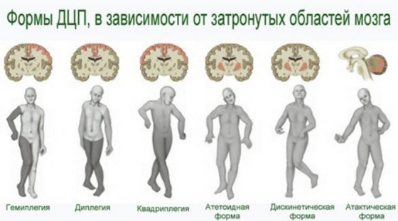 Реабилитация ДЦП по методу Лоскутовой B5c7cfcc95